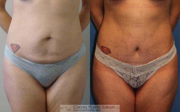 Before & After Tummy Tuck (Abdominoplasty) Case 6 View #1 View in Hingham, MA