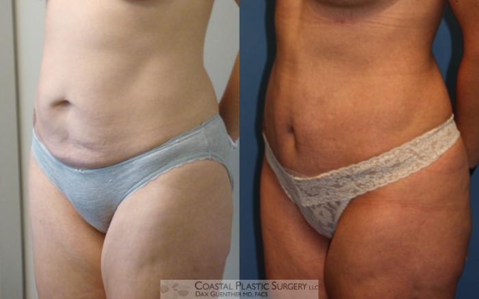Before & After Tummy Tuck (Abdominoplasty) Case 6 View #2 View in Boston, MA