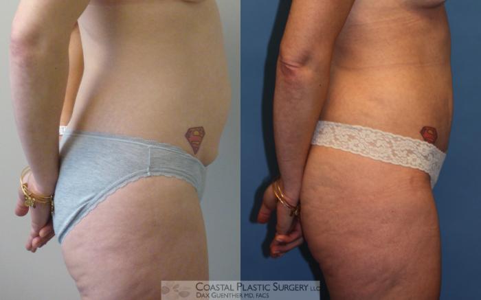 Before & After Tummy Tuck (Abdominoplasty) Case 6 View #3 View in Boston, MA