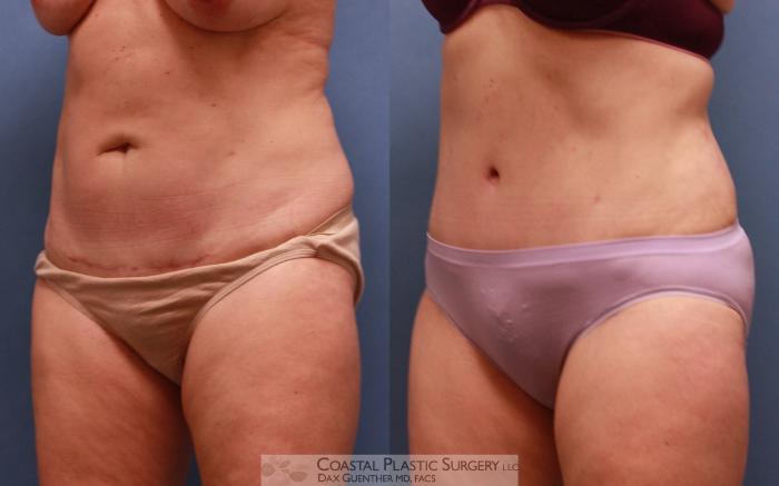 Before & After Tummy Tuck (Abdominoplasty) Case 64 View #3 View in Hingham, MA