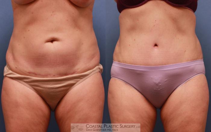 Before & After Tummy Tuck (Abdominoplasty) Case 64 View #4 View in Boston, MA
