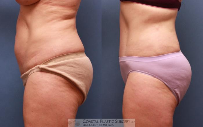 Before & After Tummy Tuck (Abdominoplasty) Case 64 View #5 View in Boston, MA