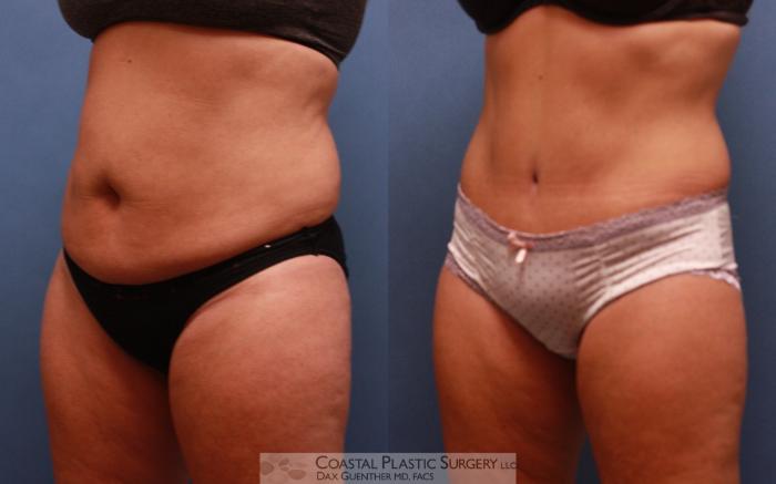 Before & After Tummy Tuck (Abdominoplasty) Case 66 View #1 View in Boston, MA