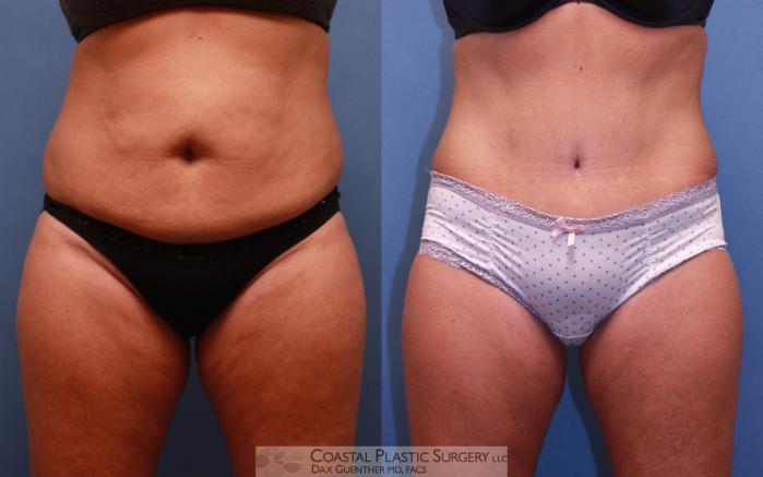 Before & After Tummy Tuck (Abdominoplasty) Case 66 View #2 View in Boston, MA