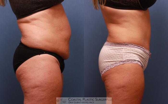 Before & After Tummy Tuck (Abdominoplasty) Case 66 View #3 View in Boston, MA