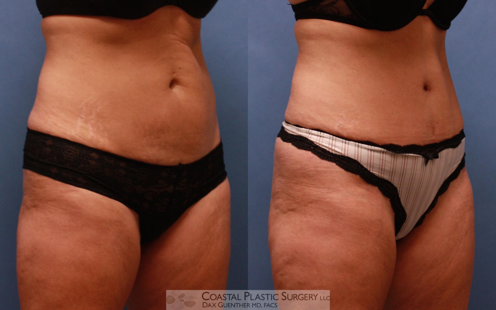 Before & After Tummy Tuck (Abdominoplasty) Case 67 View #2 View in Hingham, MA