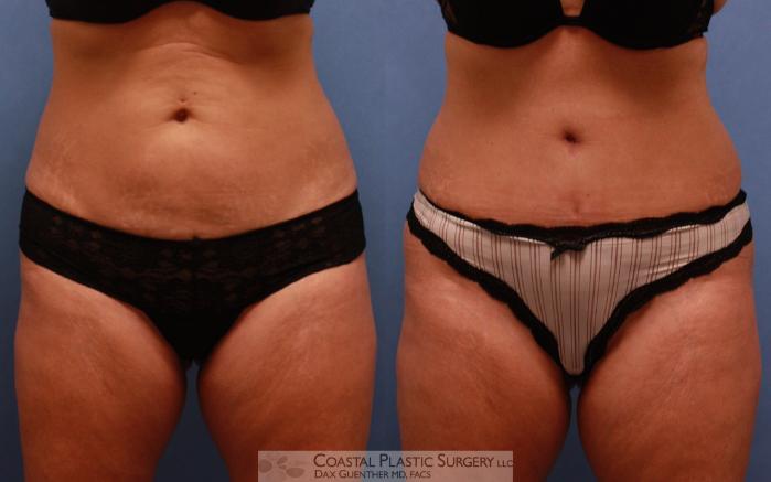Before & After Tummy Tuck (Abdominoplasty) Case 67 View #4 View in Boston, MA