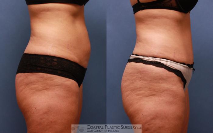 Before & After Tummy Tuck (Abdominoplasty) Case 67 View #5 View in Boston, MA