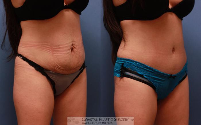 Before & After Tummy Tuck (Abdominoplasty) Case 68 View #1 View in Hingham, MA