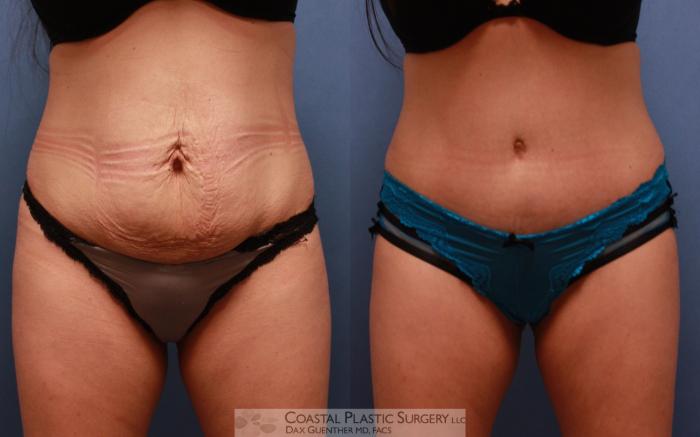 Before & After Tummy Tuck (Abdominoplasty) Case 68 View #2 View in Boston, MA