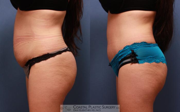 Before & After Tummy Tuck (Abdominoplasty) Case 68 View #3 View in Boston, MA