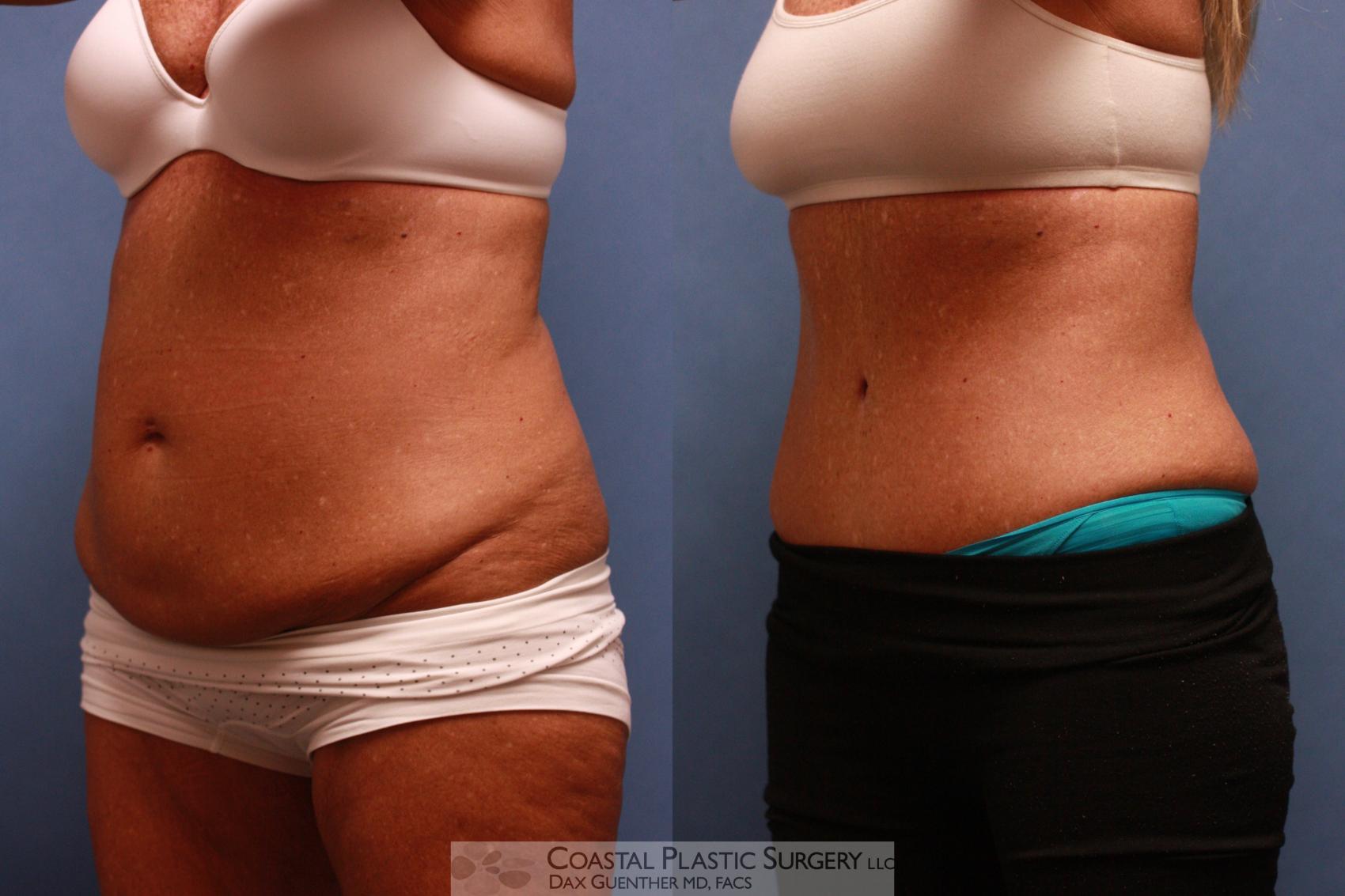 Tummy Tuck Boston, Abdominoplasty Procedure