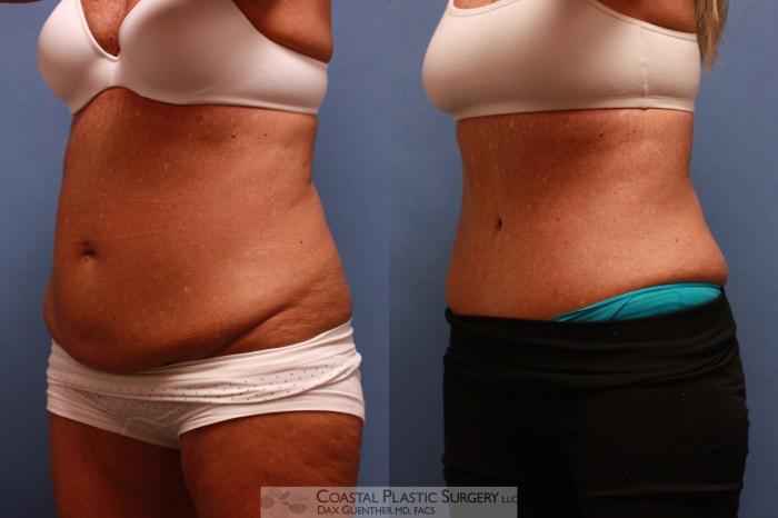 Before & After Tummy Tuck (Abdominoplasty) Case 82 View #1 View in Hingham, MA