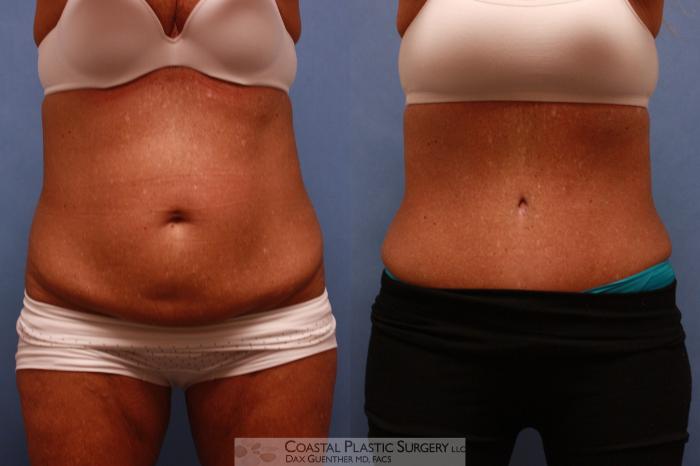 Before & After Tummy Tuck (Abdominoplasty) Case 82 View #2 View in Boston, MA