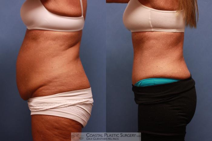 Before & After Tummy Tuck (Abdominoplasty) Case 82 View #3 View in Boston, MA