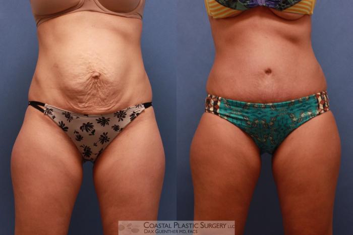 Before & After Tummy Tuck (Abdominoplasty) Case 88 View #2 View in Boston, MA