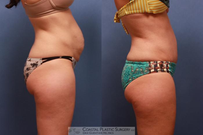 Before & After Tummy Tuck (Abdominoplasty) Case 88 View #3 View in Boston, MA