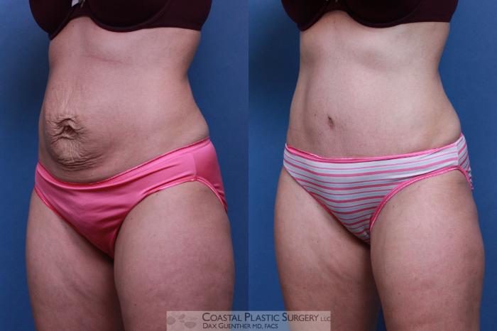 Before & After Tummy Tuck (Abdominoplasty) Case 94 View #1 View in Hingham, MA