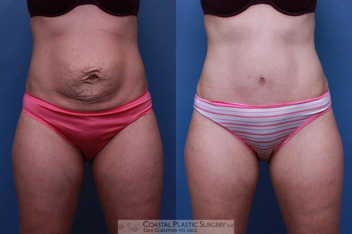 Before & After Tummy Tuck (Abdominoplasty) Case 94 View #2 View in Boston, MA