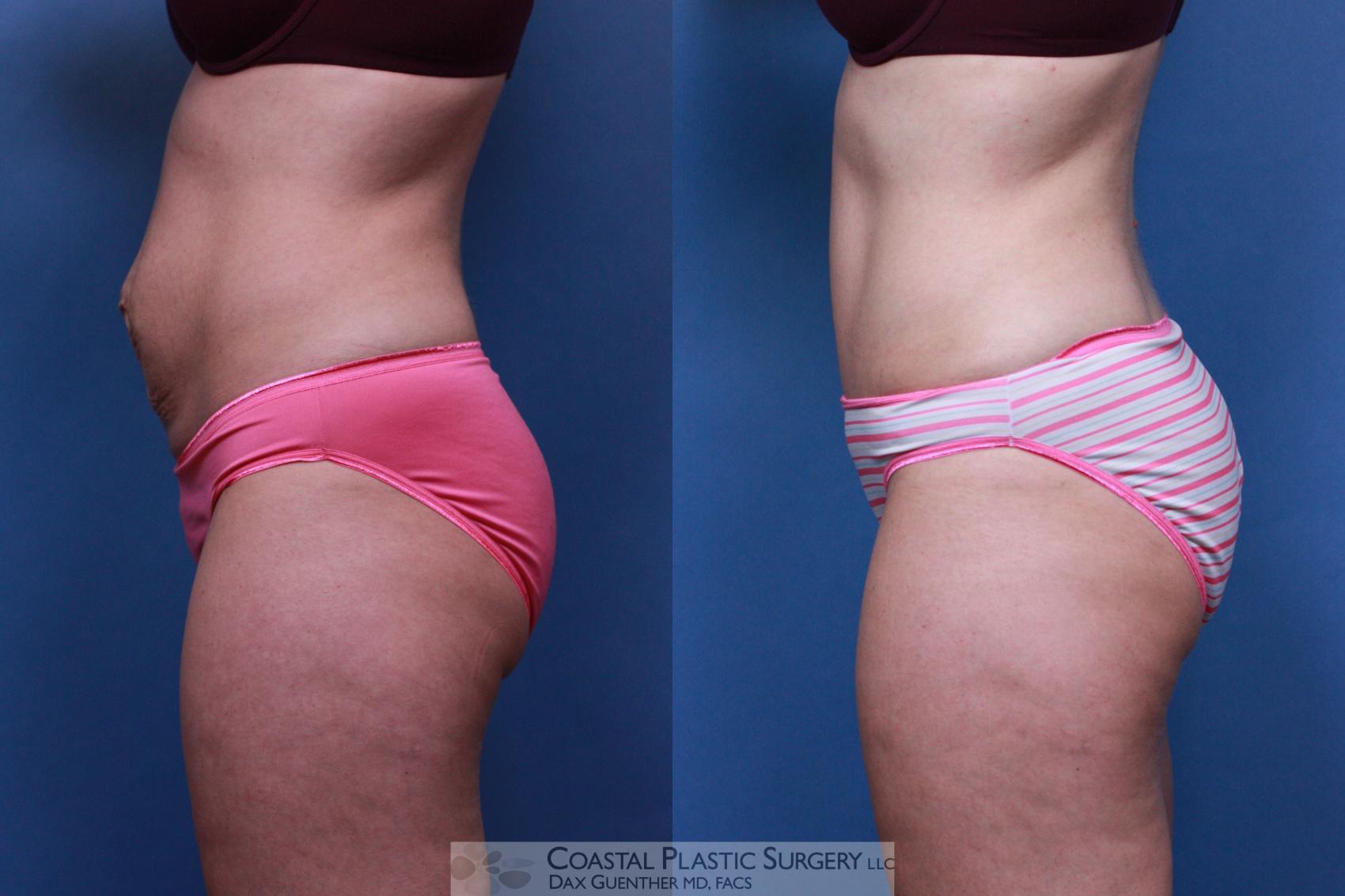 Before & After Tummy Tuck (Abdominoplasty) Case 94 View #3 View in Boston, MA