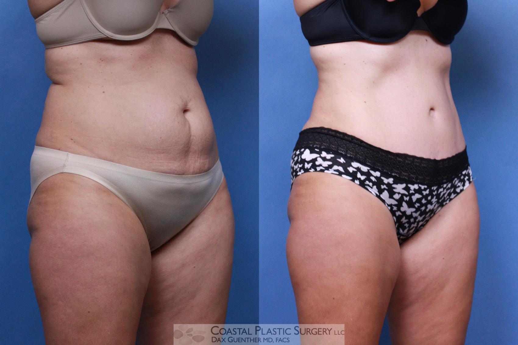 Before & After Tummy Tuck (Abdominoplasty) Case 96 View #1 View in Hingham, Boston & Nantucket, MA