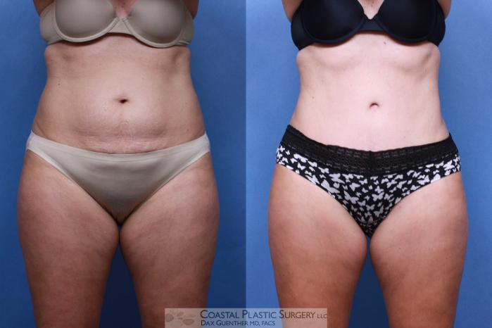 Before & After Tummy Tuck (Abdominoplasty) Case 96 View #2 View in Boston, MA