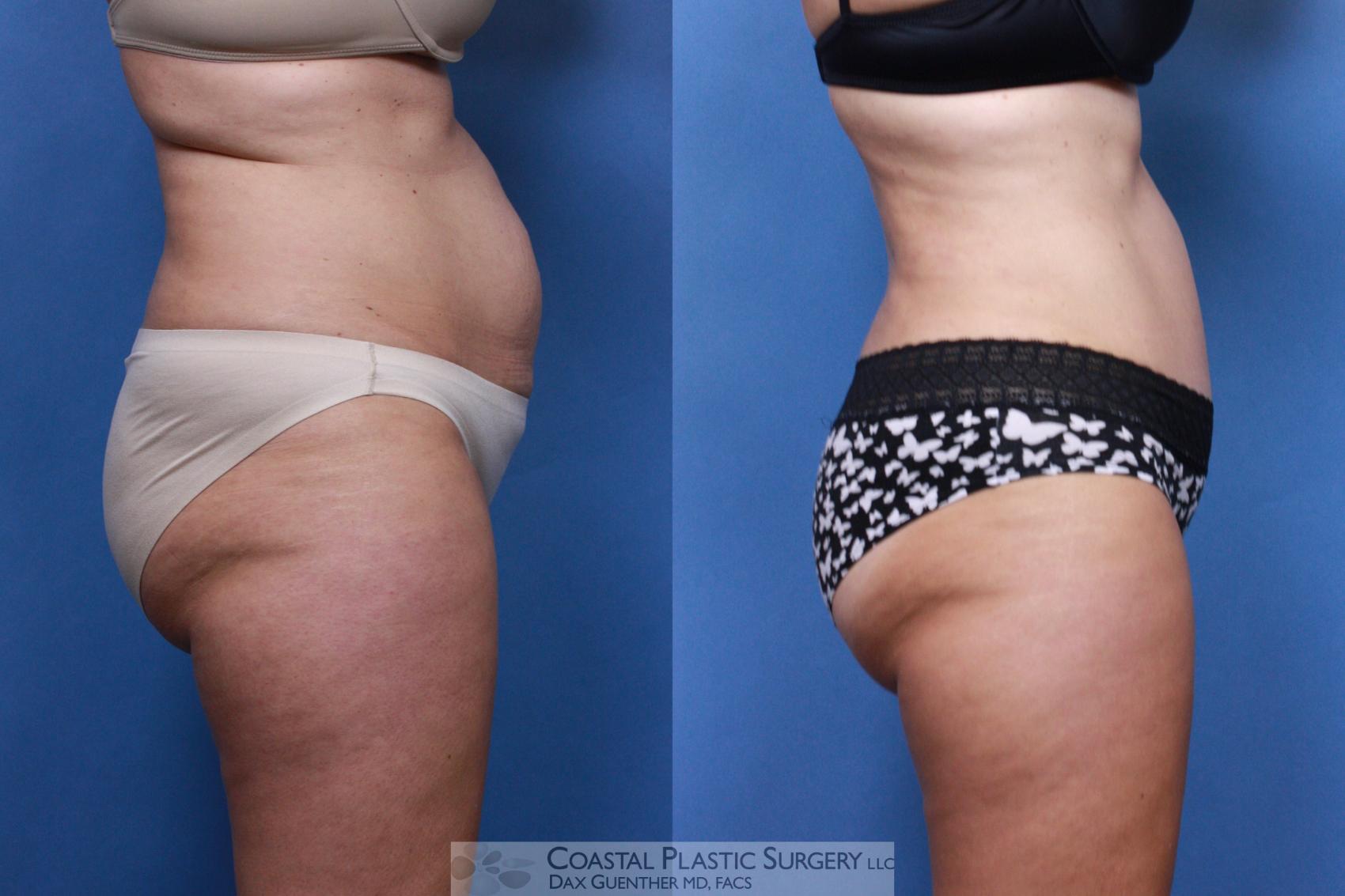 Before & After Tummy Tuck (Abdominoplasty) Case 96 View #3 View in Boston, MA