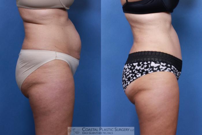 Before & After Tummy Tuck (Abdominoplasty) Case 96 View #3 View in Boston, MA